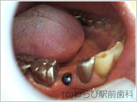 2. インプラントを希望されたので、抜歯と同時にその穴にインプラントを埋入。